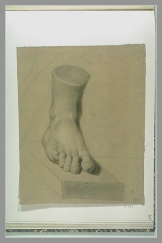 Etude d'un moulage de pied droit présentant une déformation du petit doigt